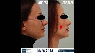 BİYOLOJİK LİFTİNG AŞISI - İNNEA AQUA