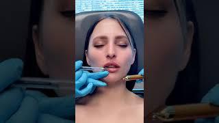Natural Lip Injections by Plastic Surgeon Dr. Seattle + Stunning Before & After Pics