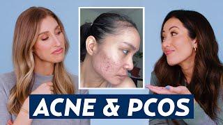 Hormonal Acne & Polycystic Ovary Syndrome PCOS Skincare Routine for Lala  DERMATOLOGIST REACTS