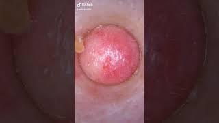 #shorts Massive forehead bug #zitpop #acne #botfly #skincare #skinroutine #IDeserveTuitionContest #c