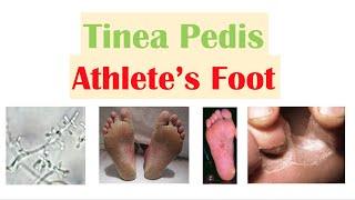 Athlete’s Foot Tinea Pedis Causes Risk Factors Signs & Symptoms Diagnosis and Treatment