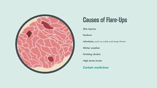 Psoriasis Signs Symptoms Causes and Treatment  Merck Manual Consumer Version