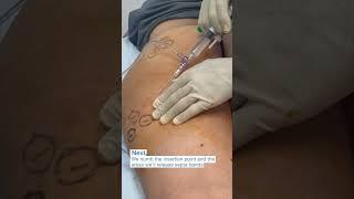 Aveli Cellulite Reduction with Dr  Zuri in Miami  Zuri Plastic Surgery