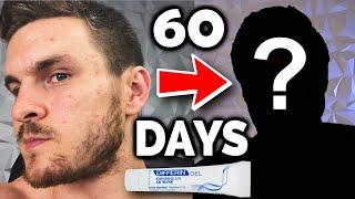 I Tried Differin For 60 Days & Heres What Happened