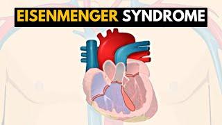 Eisenmenger Syndrome Explained A Comprehensive Guide