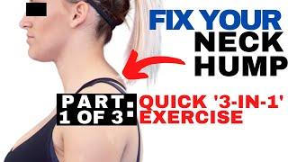 QUICK Fix for Neck Hump  Dowagers Hump Fix  How to Get Rid of a Neck Hump