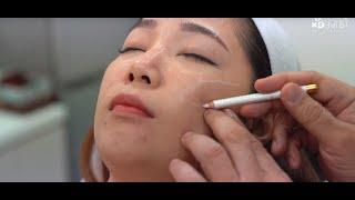 Treatment For Facial Skin Laxity The True Lift Technique