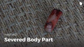 Learn first aid gestures Severed Body Part