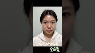 연예인도 했다는 그 수술⁉️