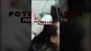 7 Benefits of Fotona Laser for hair growth  Hair treatment  HairMD Pune