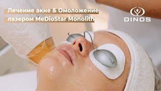 Лечение и омоложение кожи с помощью лазера MeDioStar Monolith в медицинском центре DINOS