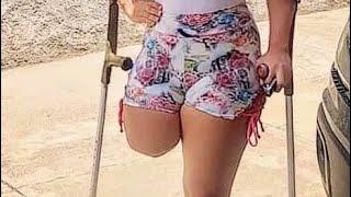 The beautiful woman with an amputated leg challenges the disability of walking gracefully#amputado