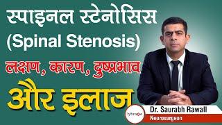 स्पाइनल स्टेनोसिस Spinal Stenosis - लक्षण कारण दुष्प्रभाव और इलाज  Dr. Saurabh Rawall  Lybrate