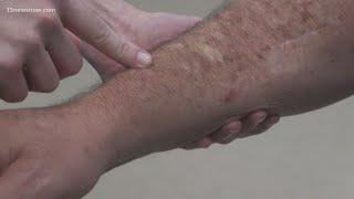 Skin Cancer How to spot melanoma warning signs