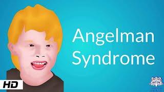 Angelman Syndrome Causes Signs and Symptoms Diagnosis and Treatment.