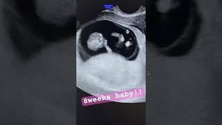 8 weeks baby in sonography wid teeny tiny limbs #ultrasound #gynaecologist #baby