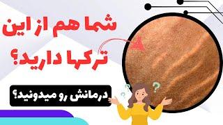 آیا شما هم روی پوستتون این ترک ها دارید؟ توی این ویدئو همه چی رو بهتون میگم