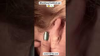 Blackhead Behind Ear #oddlysatisfying #sick #blackhead #pimplepopper #satisfying #cyst #wow #acne