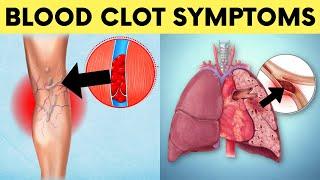 Top 10 Unusual Blood Clot Signs and Symptoms You Must Know