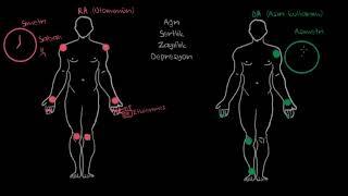 Osteoartrit ve Romatoid Artrit Semptomları Fen Bilimleri Sağlık ve Tıp