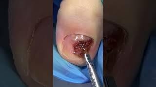 Pedicure on bruised toenail