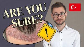 Hair Transplant in Turkey A Warning From An Expert 2023