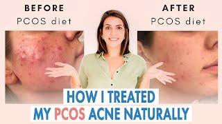 How I Healed My Cystic Acne NATURALLY PCOS & Hormonal Acne