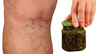 Incredible Varicose veins disappear with the help of rosemary A treasure that everyone should have