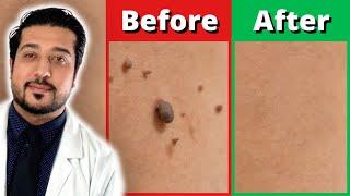 How to Rid Skin Tags FASTER  3 Easy Skin Tag Removal Steps