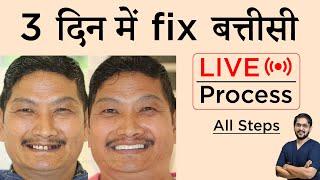 Full Mouth Fix Teeth in 3 Days In Arunachal Pradesh  3 दिन में फिक्स बत्तीसी  Live  Dr. Ankit