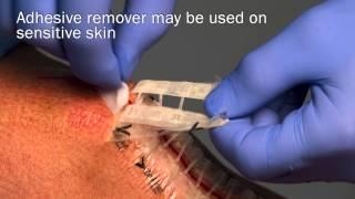 Zip Surgical Skin Closure - MDEA 2014 Gold Winner