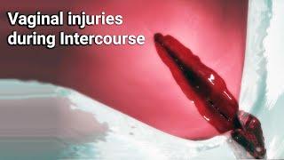 Vaginal injuries during intercourse