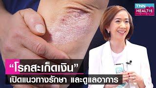 โรคสะเก็ดเงิน เปิดแนวทางรักษา และดูแลอาการป่วย l TNN HEALTH l 22 04 66