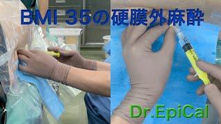 BMI 35の腰部硬膜外麻酔（施術中考えたこと）epidural anesthesia by Dr.EpiCal