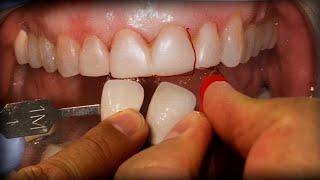 How to Make Beautiful Ceramic Veneers