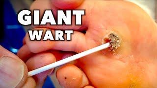 SCRAPING OFF A GIANT DEAD WART  Dr  Paul