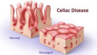 Celiac Disease