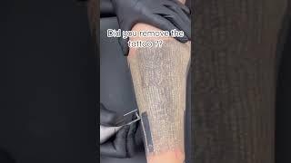 Does tattoo removal hurt? #tattoo #tattooremoval #viral