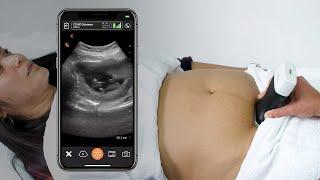 First Trimester Intrauterine Pregnancy Ultrasound Scanning Technique