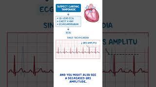 Diagnostics on Demand Cardiac tamponade