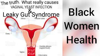 Yeast Infection & Leaky Gut Syndrome - The real cause and solution. Black Womens Health.