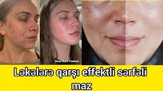 Ləkələrə qarşı maz Lekelere qarsi maz