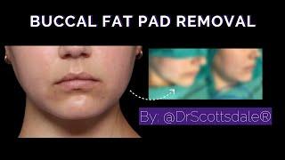 BUCCAL FAT PAD REMOVAL by @DrScottsdale