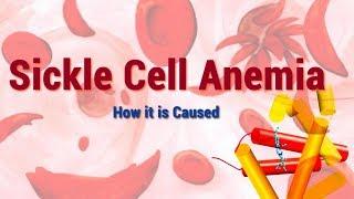 Sickle Cell Anemia  Causes Symptoms and Molecular Mechanism