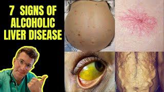 Doctor outlines 7 signs of Alcoholic Liver Disease ascites Caput Medusae jaundice & more