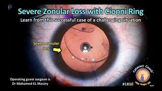 CataractCoach™1810 severe zonular loss with Cionni ring