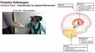 Cerebral Palsy Overview  Introduction & Classifications