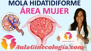 MOLA HIDATIDIFORME PARCIAL y COMPLETA. CORIOCARCINOMA. ¿Qué son? - Ginecología y Obstetricia -