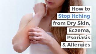 Causes & Natural Treatment for Itchy Eczema Dry Skin Psoriasis & Allergies