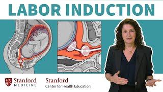 What is labor induction? OBGYN answers 5 common questions about inducing labor  Stanford